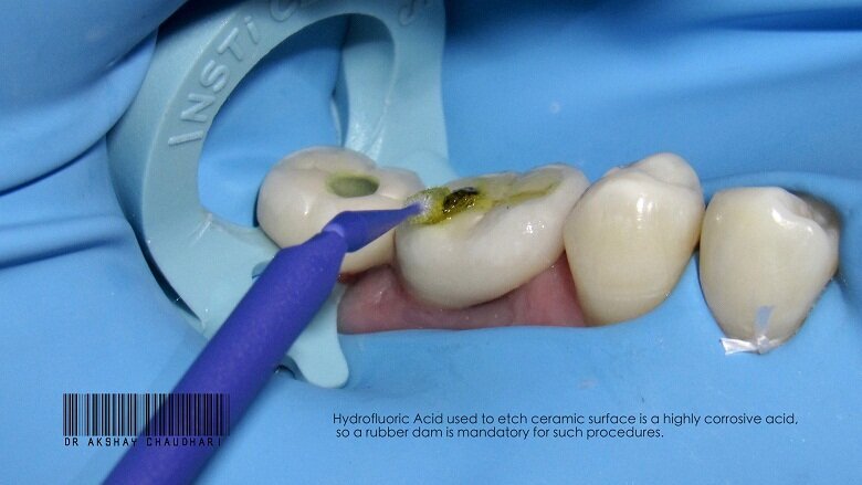 Fig - 12 Clamp on Prsothesis