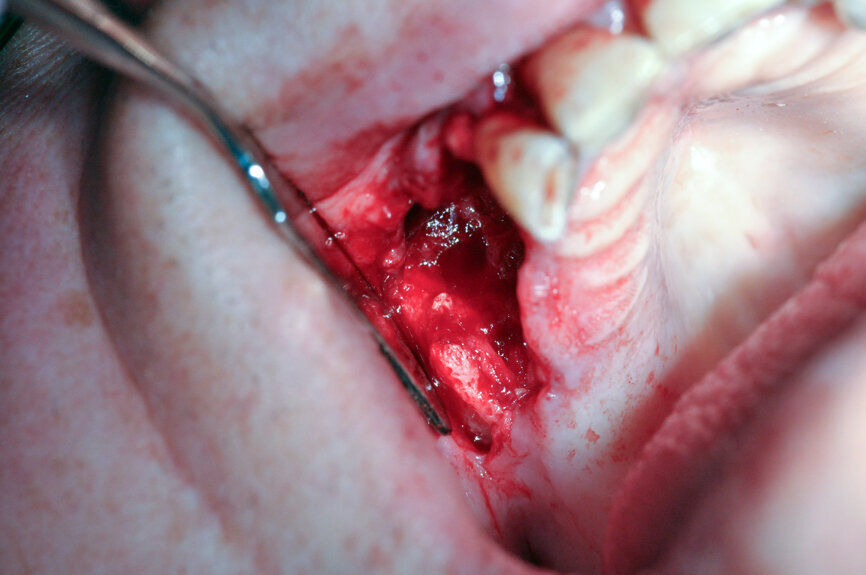 Ryc. 4_Śródzabiegowo: po chirurgii laserowej widoczna zdrowa tkanka kostna.