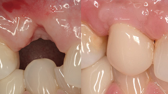 La importancia del grosor biológico
