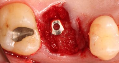 Digital peri-implant tissue healing