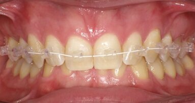 Nuovi traguardi ortodontici al servizio dell’estetica