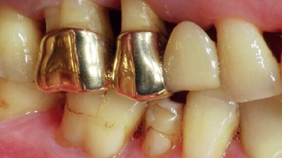 Open-healing approach to avoid flap mobilization and subsequent morbidity