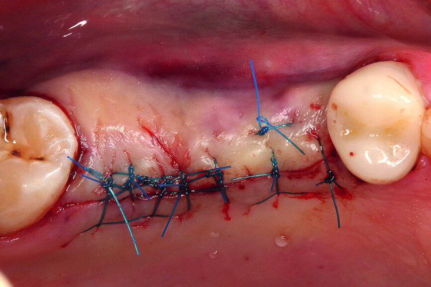 Fig. 16 : Fermeture de la plaie sans tension. 