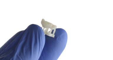 3D printing of an inlay and overlay using SprintRay’s Ceramic Crown resin: A case report