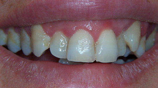 Clinical management del paziente con affollamento dentale