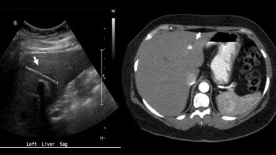 Ingeslikte tandenstoker leidt tot leverabces