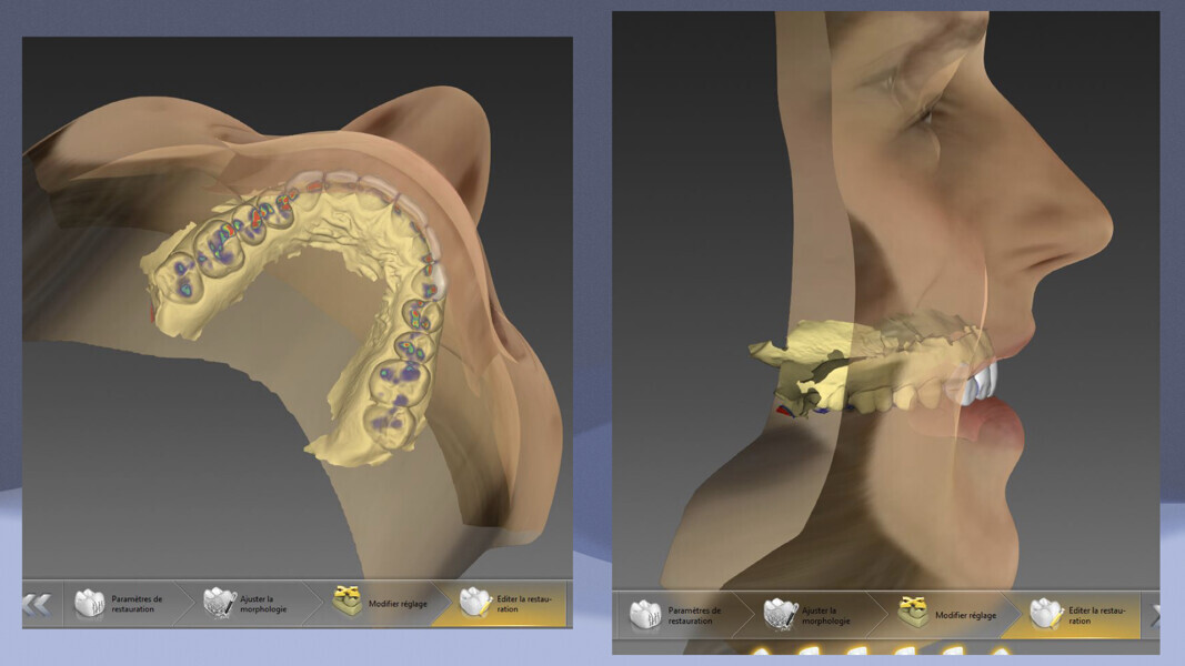 Fig. 10 : Dynamique mandibulaire dans inLab SW 22.0.