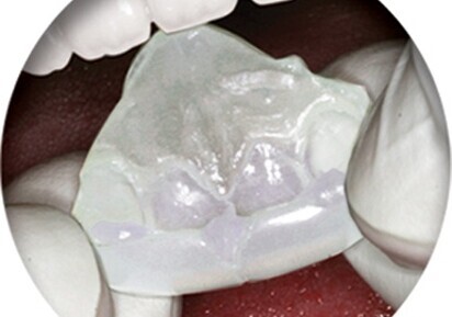 NiteBite targets bruxing