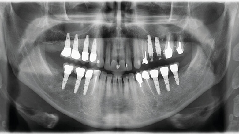 Cas clinique de chirurgie guidée : Extraction, implantation et mise en esthétique immédiate