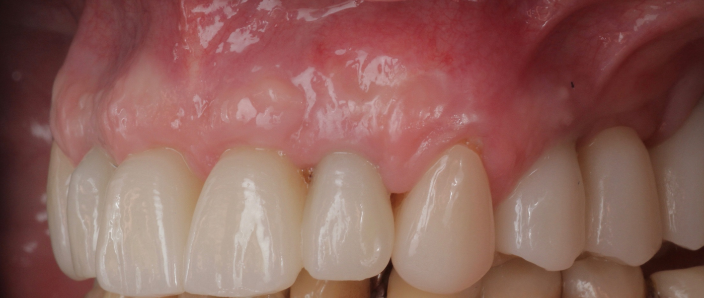Fig. 19: Right lateral aspect of the restorations after the two-year follow-up period