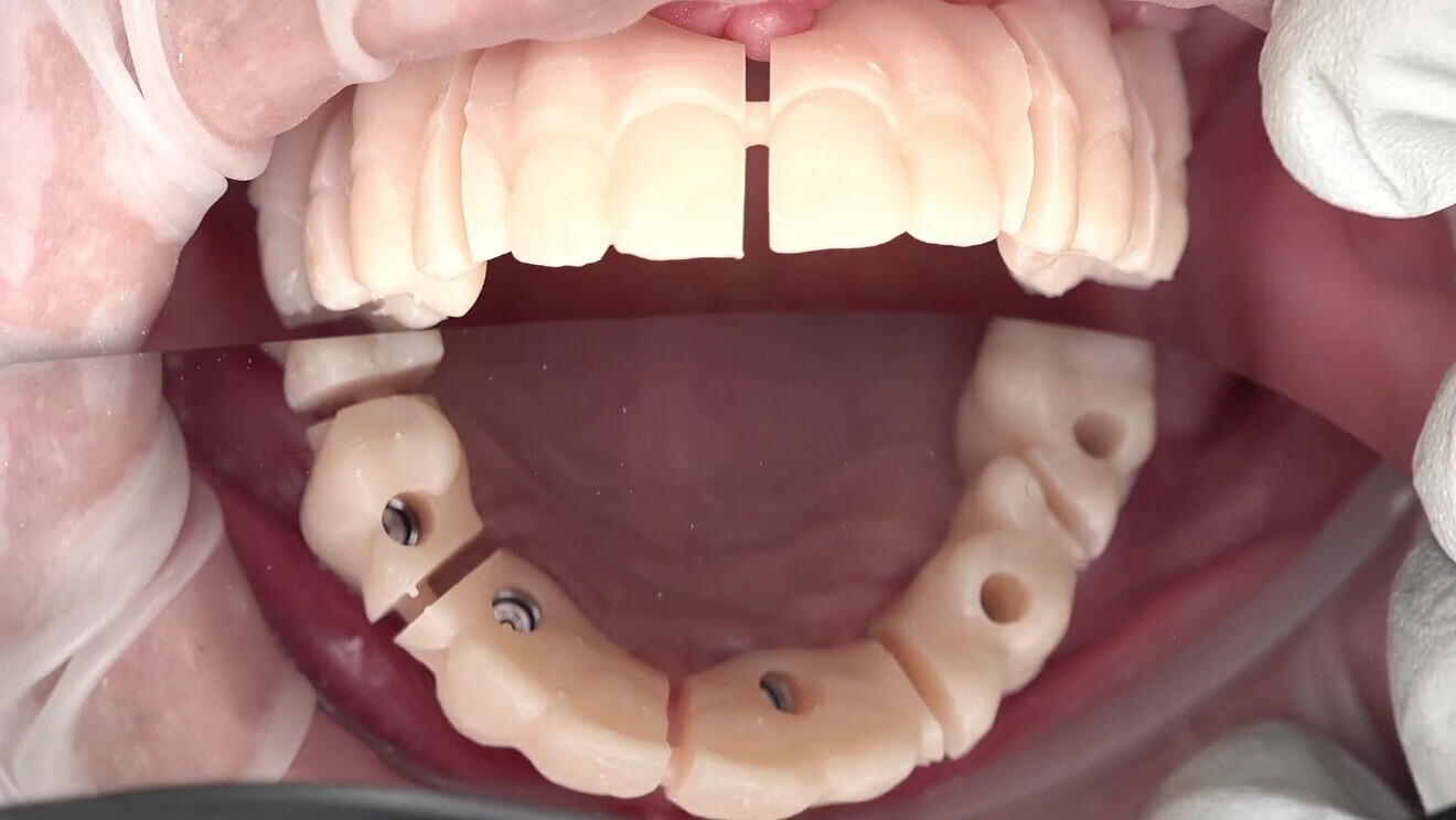 Fig. 9: Validator try-in seated in the patient’s mouth.