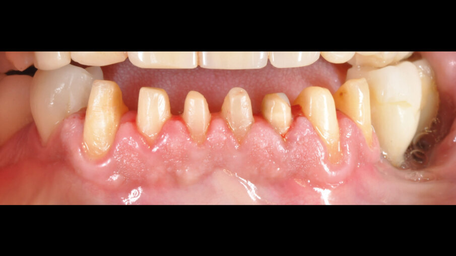 Figg. 2, 3_Preparazione gruppo frontale da 33 a 43.