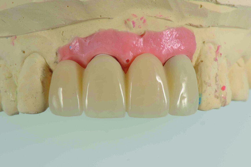 Fig. 14: Provisional restoration on the model.