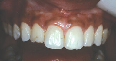 ‘Growing Enamel’ — Revisited