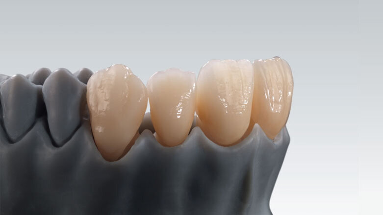 Zolid Gen-X – The new universal zirconium that changes everything