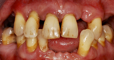 Prävalenzzahlen zu Parodontitis in Österreich „Fehlanzeige“