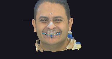 4D smile design case using exocad’s Smile Creator module and dynamic jaw motion