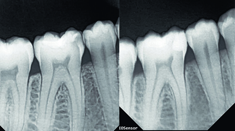 Fig. 12. IOPA before treatment and post-op showing natural contour and seal achieved with a perfect contact. 