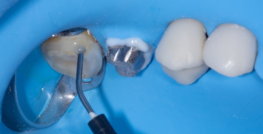 Fig. 13: G-ænial Universal Injectable was applied to the inner surface of the restoration and to the preparation.
