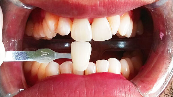 Post-hygiene whitening for everyone