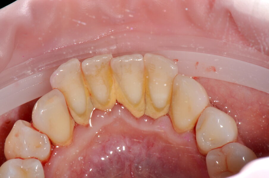 Figg. 2a-2c - Foto scattate dopo l’utilizzo del manipolo sopra-gengivale, nelle aree vestibolare (2a), palatale (2b) e linguale (2c), senza la detartrasi con strumento piezoelettrico.