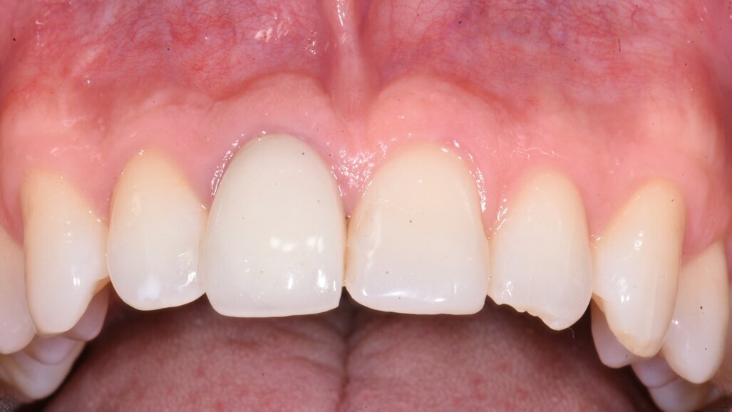 Resonance frequency analysis—the only longitudinal metric for implant stability