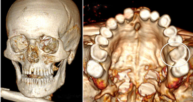 “IJsman” had rampzalig gebit