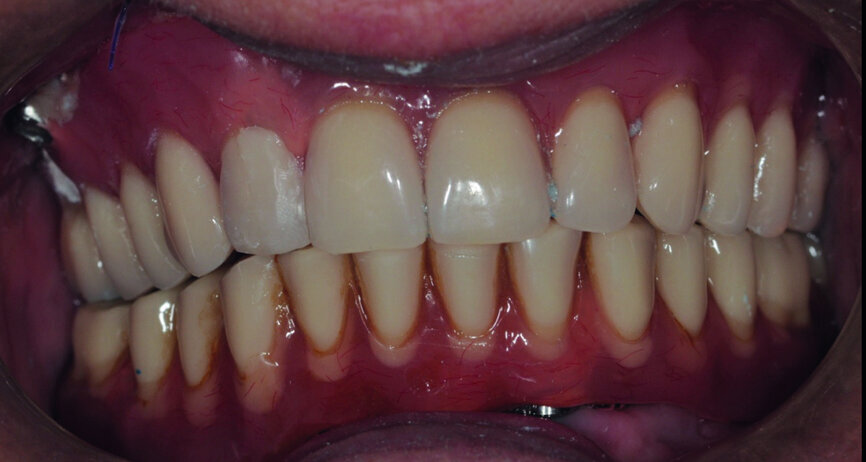 Fig. 7 : Bridges terminés. 