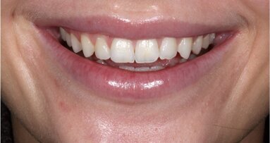 Verbeter je glimlach met composiet