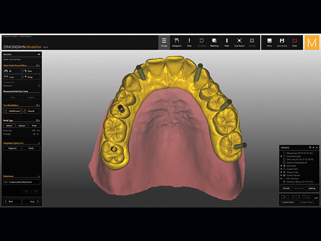 Při použití MUA 17 ° vystupují kanály pro šroubky přímo na okluzních ploškách, čímž nijak neovlivňují estetický výsledek.
