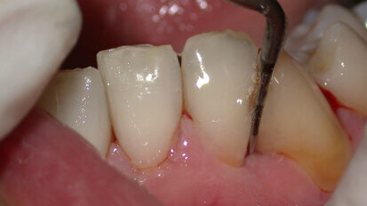 Come è cambiata la terapia parodontale non chirurgica