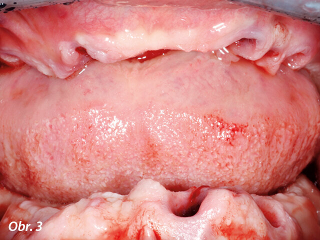 Extrakce všech poškozených zubů a implantátů.