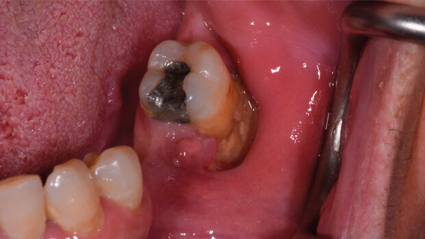 Prevenzione e management odontoiatrico dei pazienti oncologici a rischio di osteonecrosi delle ossa mascellari da farmaci