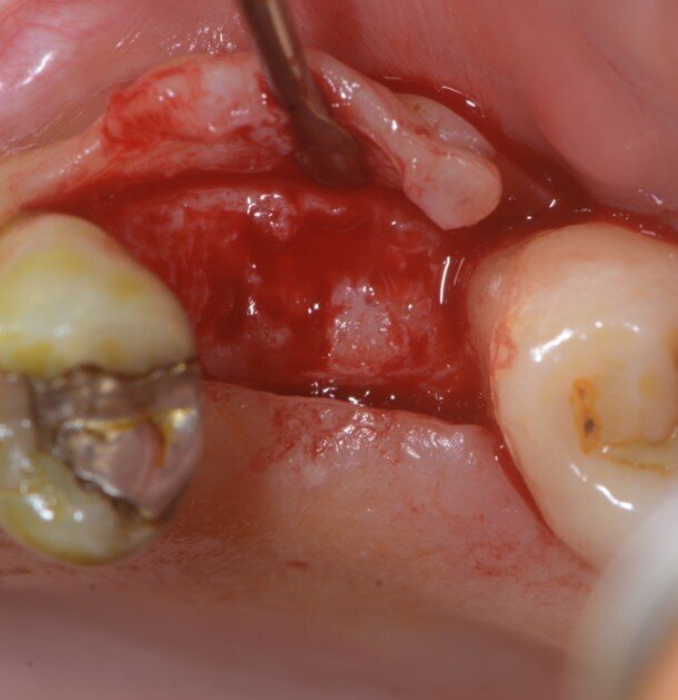 Fig. 9 - Rientro a 4 mesi.