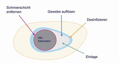 Die Desinfektion des Wurzelkanals