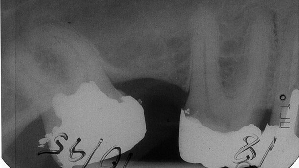 Die Vitalamputation permanenter Zähne