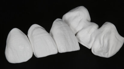 Fig. 8: Milled monolithic restorations with a pronounced surface texture.