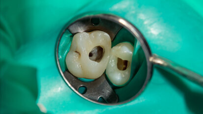 Hybrid shaping with MG3 rotary system