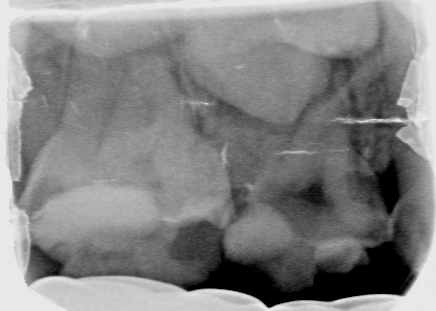 Afbeelding 3a: Röntgenfoto's op de leeftijd van 6 jaar, juli 2018.