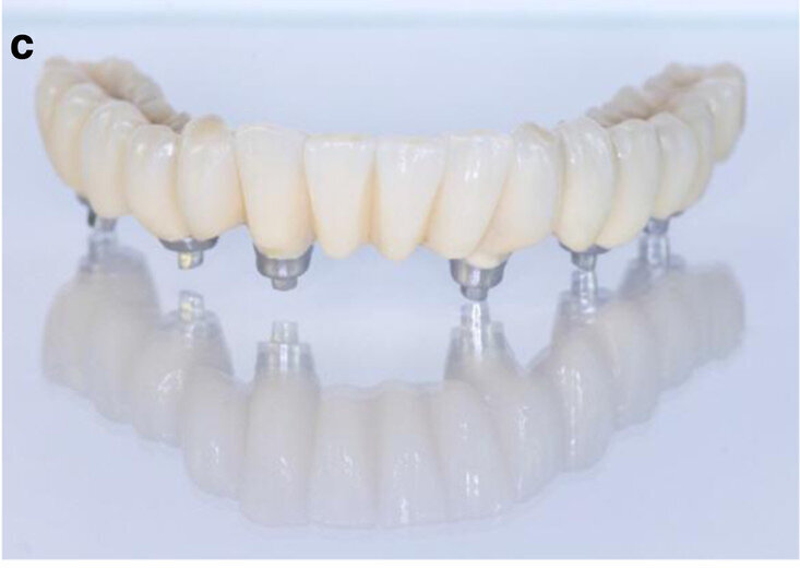 Fig. 13c: CAD/CAM-fabricated one-piece cobalt–chromium framework before (a & b) and after veneering with composite (SR Nexco Paste, Ivoclar Vivadent), that is the final FDP (c & d).