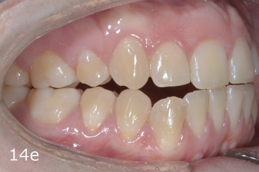 Figs. 14a–h: Intra-oral comparison of the situation (a, d, e & h) before and (b, c, f & g) after treatment.