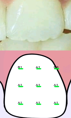 Mobile shade match showing maximum A1 shade.