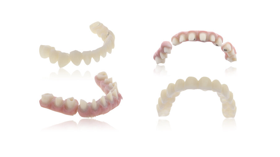 Fig. 6: Zirconia thimble framework and  BRILLIANT Crios bridges for extra oral bonding. 