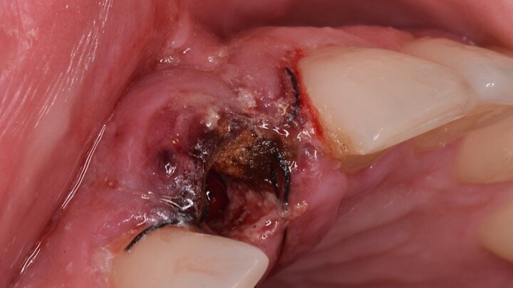 Figura 15. Observamos el aumento de volumen obtenido por vestibular ante un defecto muy grande. Además, en la emergencia del implante se pueden apreciar las partículas inmersas en la fibrina que posteriormente formarán el nuevo tejido conectivo con el biomaterial en su interior.