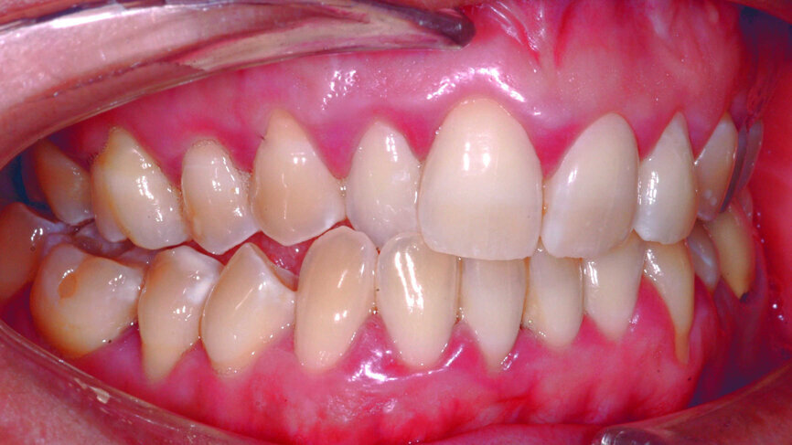 Fig. 2 : Vue latérale préopératoire.