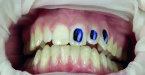 Fig. 2: Professional diagnosis to raise patient awareness with a plaque test (GC)