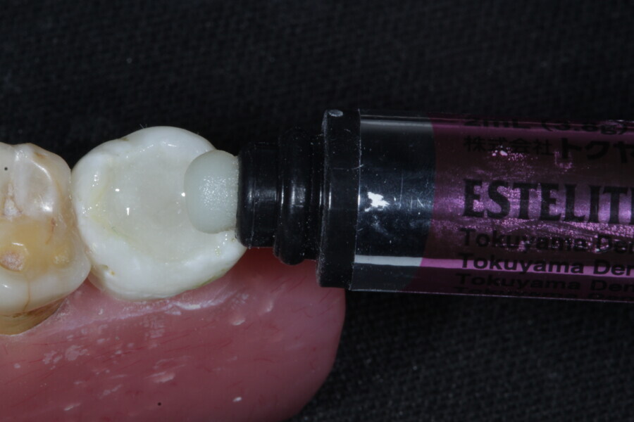 Fig. 30: The final occlusal layer of the restoration is placed using an enamel supra-nano hybrid composite in Shade A2 (Estelite).