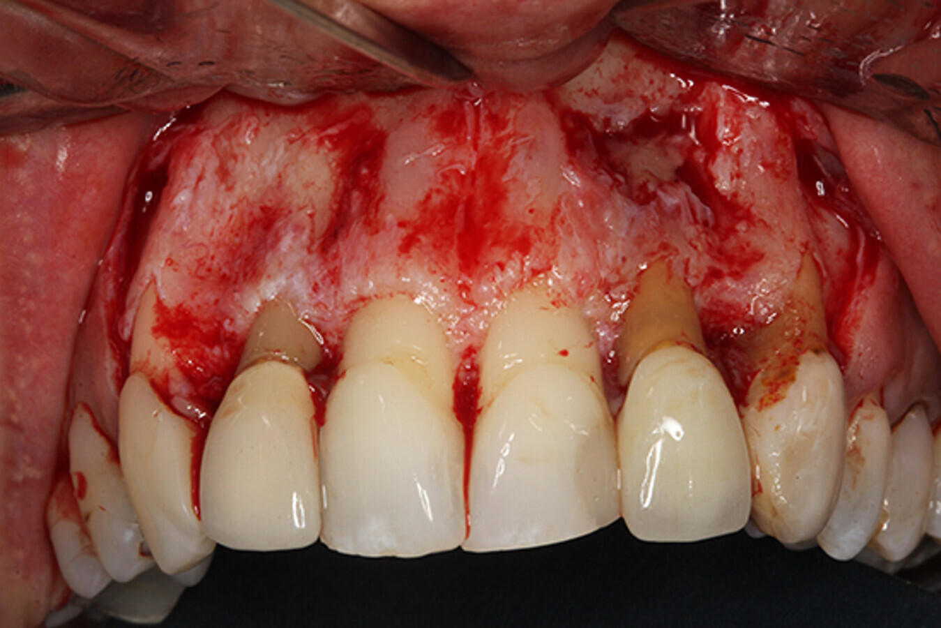 Figura 4. DiseÃ±o de un colgajo de Neumann trapezoidal con incisiÃ³n intrasulcular y descargas verticales vestibulares bilaterales.