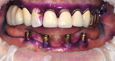 Guided Biofilm Therapy: The optimal solution for implant maintenance