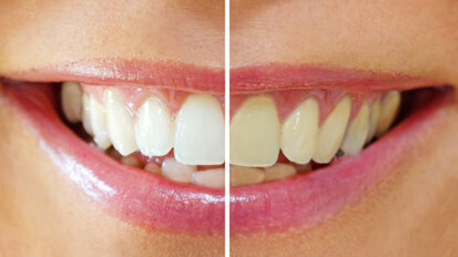 Neue SSO-Broschüre zum Thema Bleaching